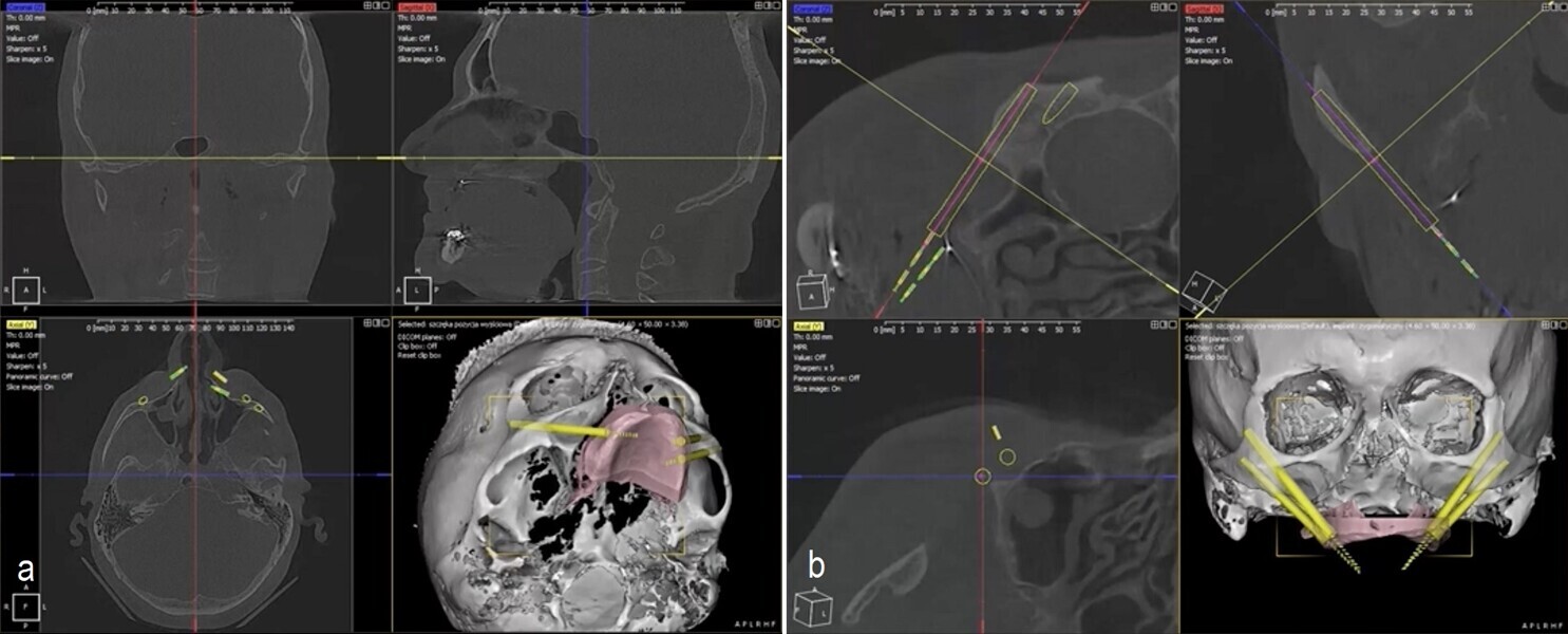 Figs. 3a & b: Digital planning of the zygomatic implant site preparation and creation of anchor pin holes using DDS-Pro software.