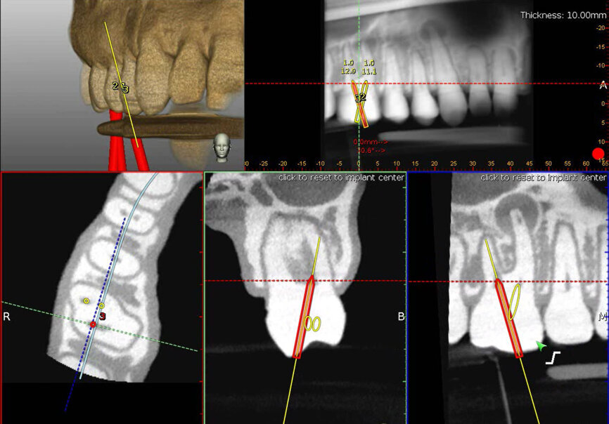 Fig. 4b: The red virtual pathway reflects an off-angle positioning. (Courtesy of Dr Bobby Nadeau)