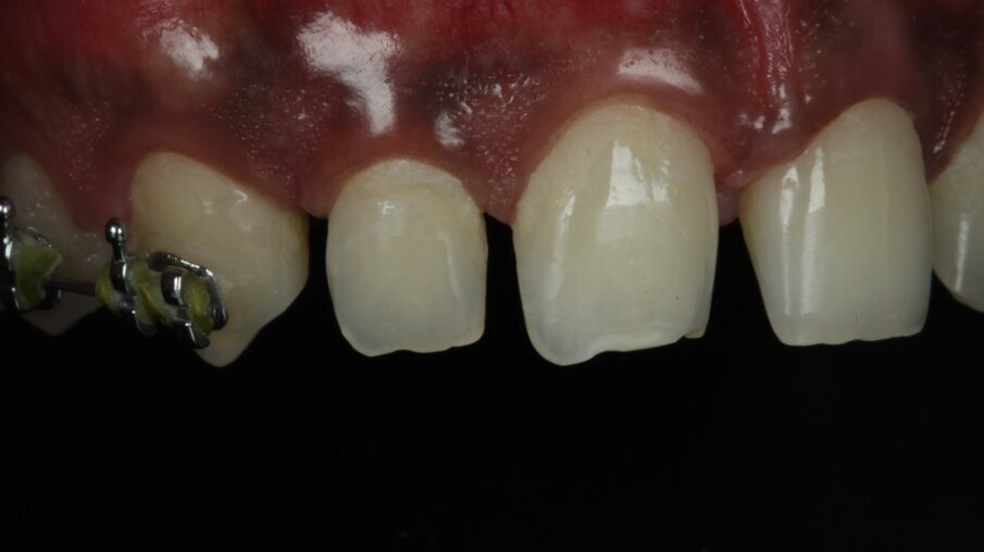 Fig 8: Maxillary incisors brackets debonded