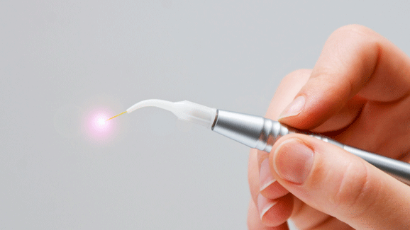 Löcher in Zähnen mit dem Laser auffüllen