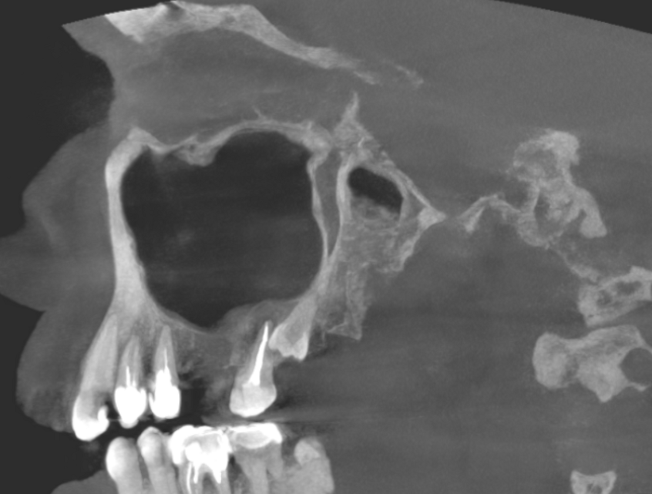 Fig. 8b: Sagittal cross-section of the palatal root showing full recovery of the periapical bone (b).
