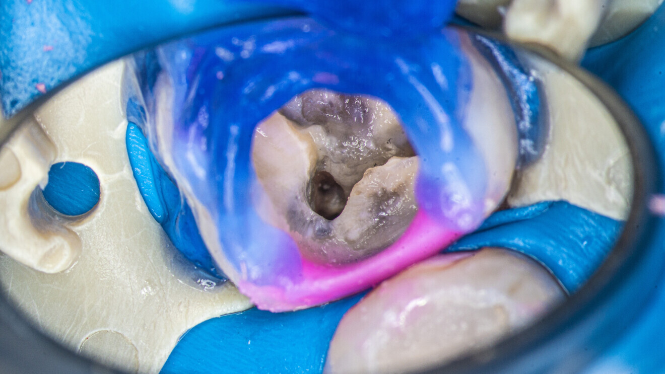 Fig. 31: Apparent over-instrumentation of the root canal orifice, probably performed with ultrasonics during a previous attempt at broken file removal.
