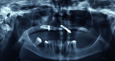 Estetica e funzione: approccio moderno alla riabilitazione del paziente totalmente edentulo