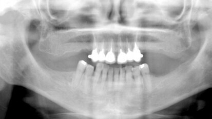 El tratamiento con ozono de la osteonecrosis asociada a bifosfonatos