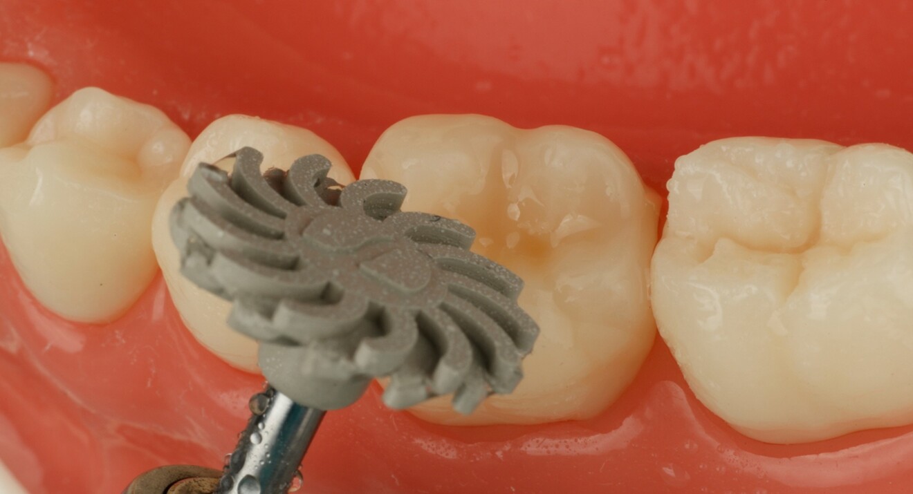 Fig. 2e: Finishing and polishing with Enhance Flex.