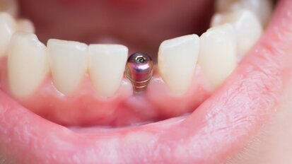 Retrospective analysis of periimplantitis therapy of 158 implants