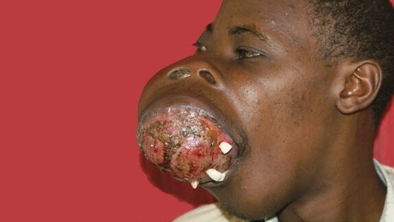 Plastic surgeons remove large jaw tumours