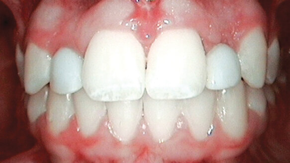 Replacing congenitally missing lateral incisors