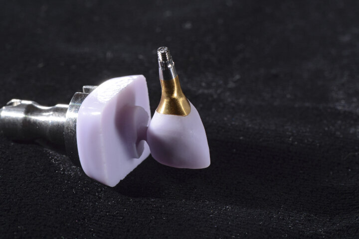 Fig. 7: Full ceramic crown milled in the CEREC CAD/CAM system before sintering. As can be seen in the image, the Atlantis abutment and
the crown would fit perfectly together.