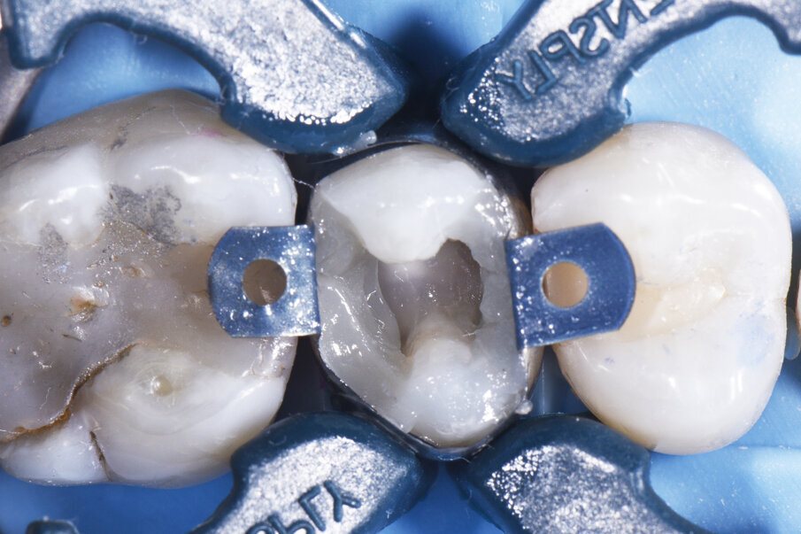 Marginal ridge formation using A2 ceram.x® SphereTEC™ one. Removal of sectional matrix assembly after this stage. Finish like a Class I restoration.