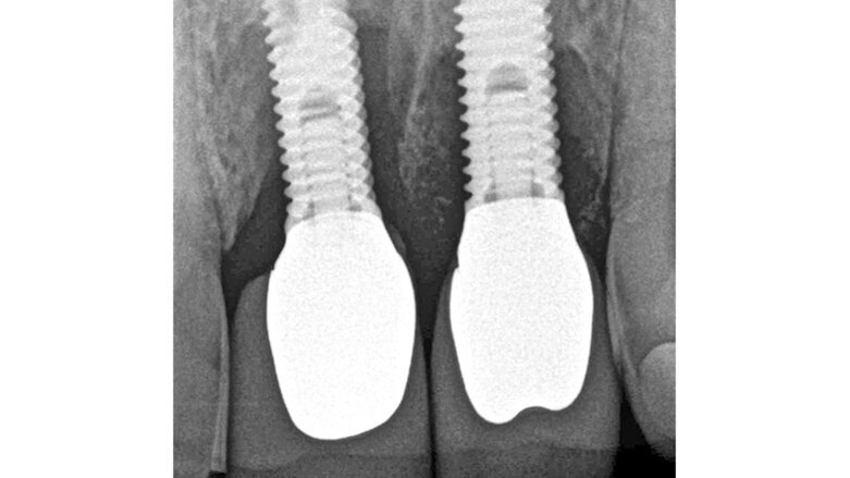 Terapie periimplantitidy při použití resorbovatelného, náhradního kostního materiálu