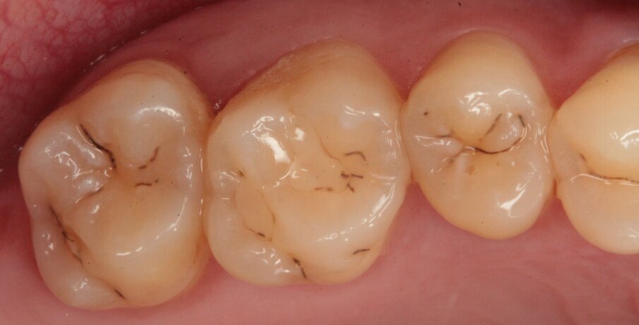 Fig. 5_Visione occlusale di 16 e 17.