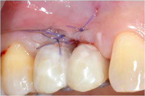 Fig. 8_Al termine della chirurgia la paziente è stata dimessa con due corone provvisorie avvitate.