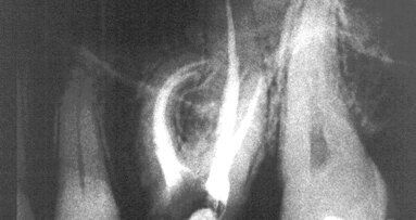 Taktilna percepcija u endodonciji