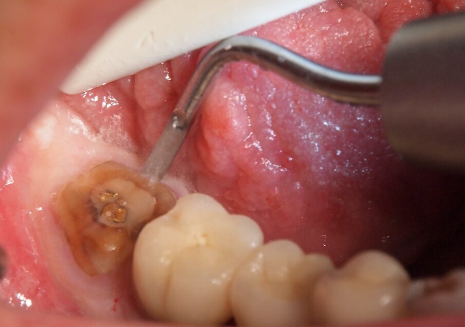 Fig. 12 - Inserti per allungamento clinico di corona con tecnica flapless. Gli inserti sono lisci sui lati e lavoranti esclusivamente in punta senza il rischio di provocare alterazioni o danni alla struttura dentale. Possono eseguire osteoplastiche mirate con precisione micrometrica e minima invasività.