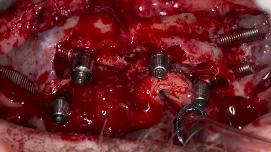 Fig. 5 - Fotografia intraoperatoria dopo l’inserimento del 4 impianti zigomatici, con relativi monconi, nel mascellare superiore.