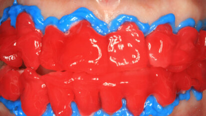 Protocollo clinico per il trattamento cosmetico di sbiancamento interno