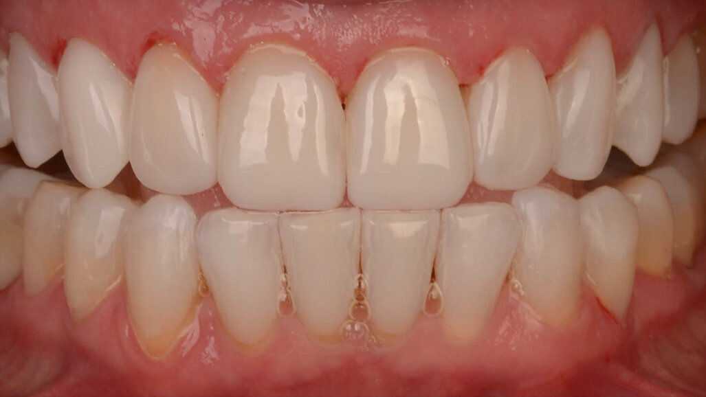 Flowable injection technique—a composite revolution with CLEARFIL MAJESTY ES Flow Low