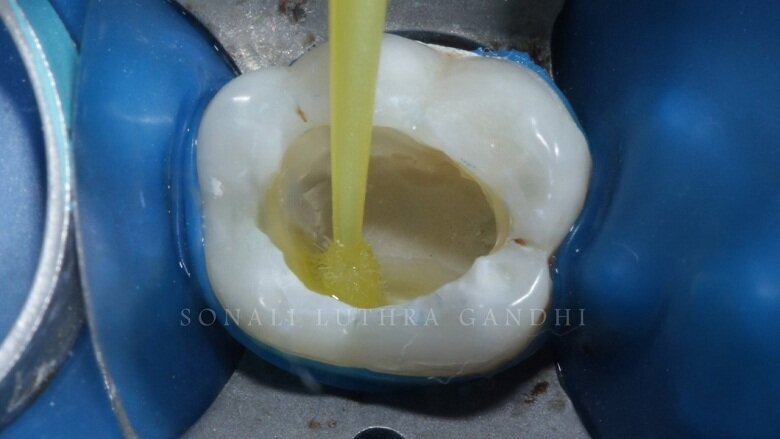 Fig 6: Application of Self etch Bond