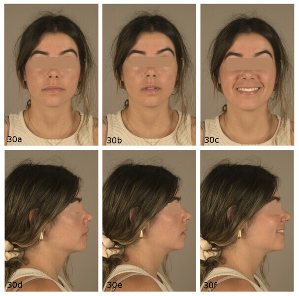 Figs. 30a–f: Post-treatment extra-oral photographs.