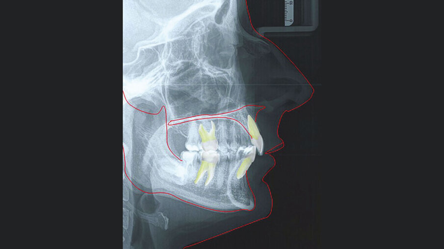 Figg. 9a-9c_Esami radiografici dopo il trattamento, con sovrapposizione sul piano SN. Questo ci mostra come, non potendo proclinare ulteriormente gli incisivi inferiori oltre la sinfisi per sfruttare l’intrusione relativa, l’apertura del morso è stata ottenuta sfruttando al massimo solo movimenti di intrusione assoluta, seppur minimi, e movimenti di intrusione relativa superiore ed estrusione posteriore parziale, considerando la difficoltà di quest’ultima, a causa della tipologia brachifacciale della paziente.