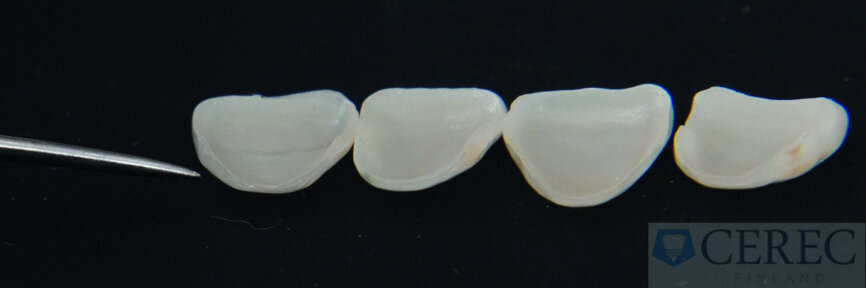 Fig. 8: Veneers produced chairside prior to fitting.