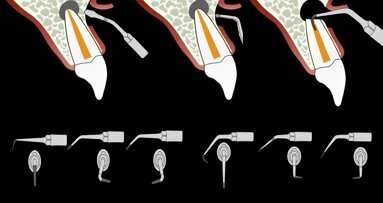 Piezocirugía  (5). El éxito de la cirugía apical en endodoncia