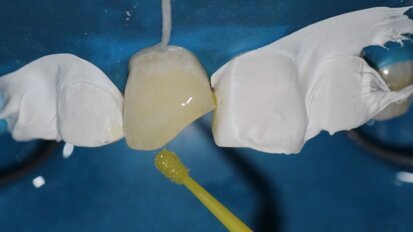 Developing tight proximal contacts in anterior teeth using Unica Anterior matrix – A case report