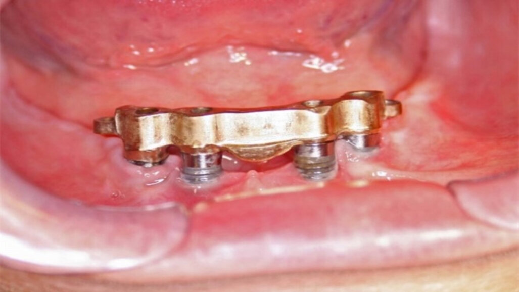 Role kovových nano a mikročástic v periimplantitidě