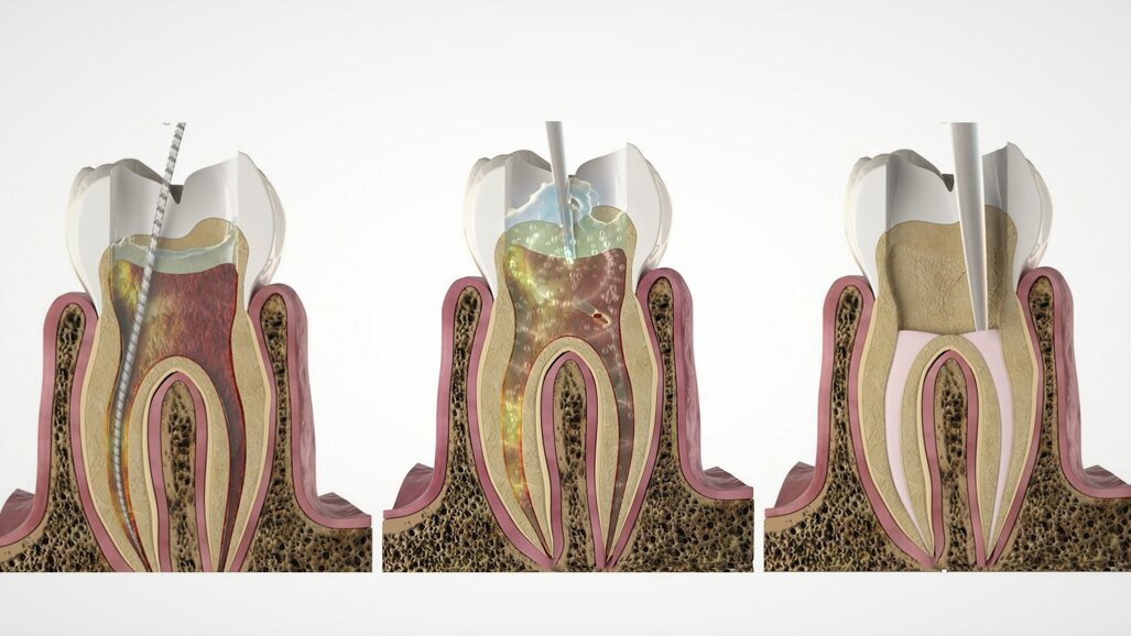 Discover SWEEPS for a more effective endodontic treatment at IDS