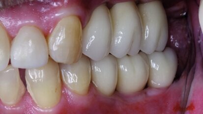 Terapia implantare in tutta sicurezza