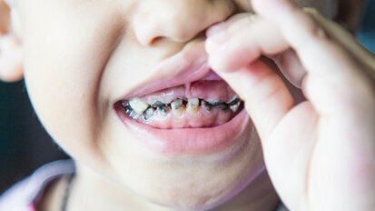 Duration of breastfeeding may impact dental caries