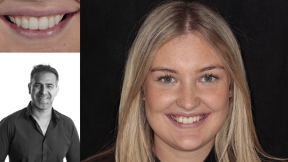 Esthetische orthodontische oplossing als alternatief voor grote restauraties