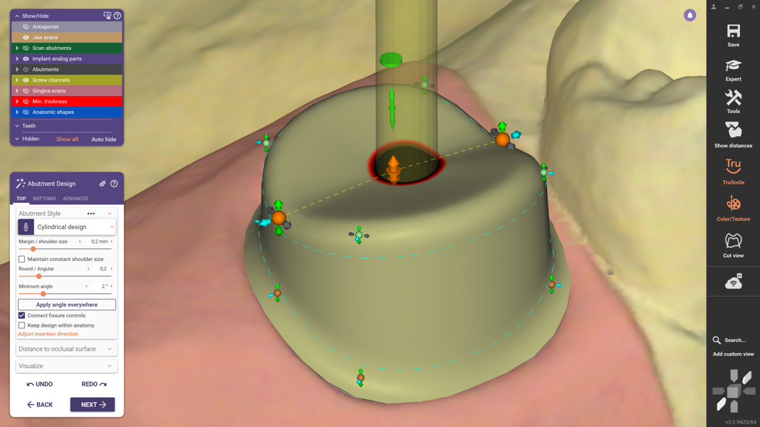 Fig. 8: The fissure line (yellow) visualises the crown fissure and can be freely adjusted in height.