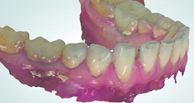 Optical impression and provisional prosthesis: Proposal for a new approach