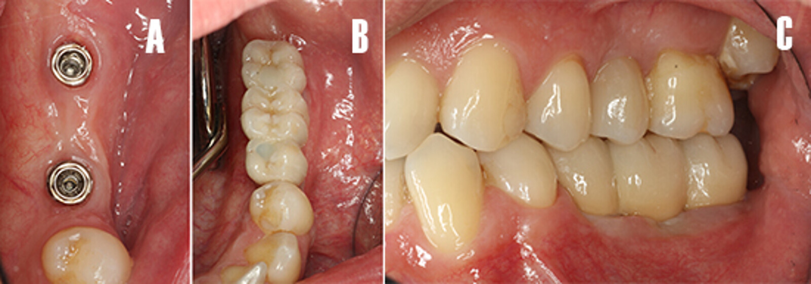 Figura 14. Fase protÃ©sica. ImÃ¡genes intraorales. A) Vista oclusal de la salud de los tejidos periimplantarios el dÃ­a de colocaciÃ³n de la prÃ³tesis. B) Vista oclusal de la prÃ³tesis ceramo-metÃ¡lica atornillada. C) Vista lateral de la prÃ³tesis definitiva, nÃ³tese el esquema oclusal de la restauraciÃ³n.