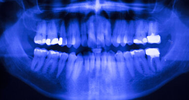 Moving away from amalgam: New online tool helps dentists choose suitable restorative materials