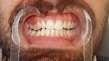 Figura 3. Cierre de diastema digital.