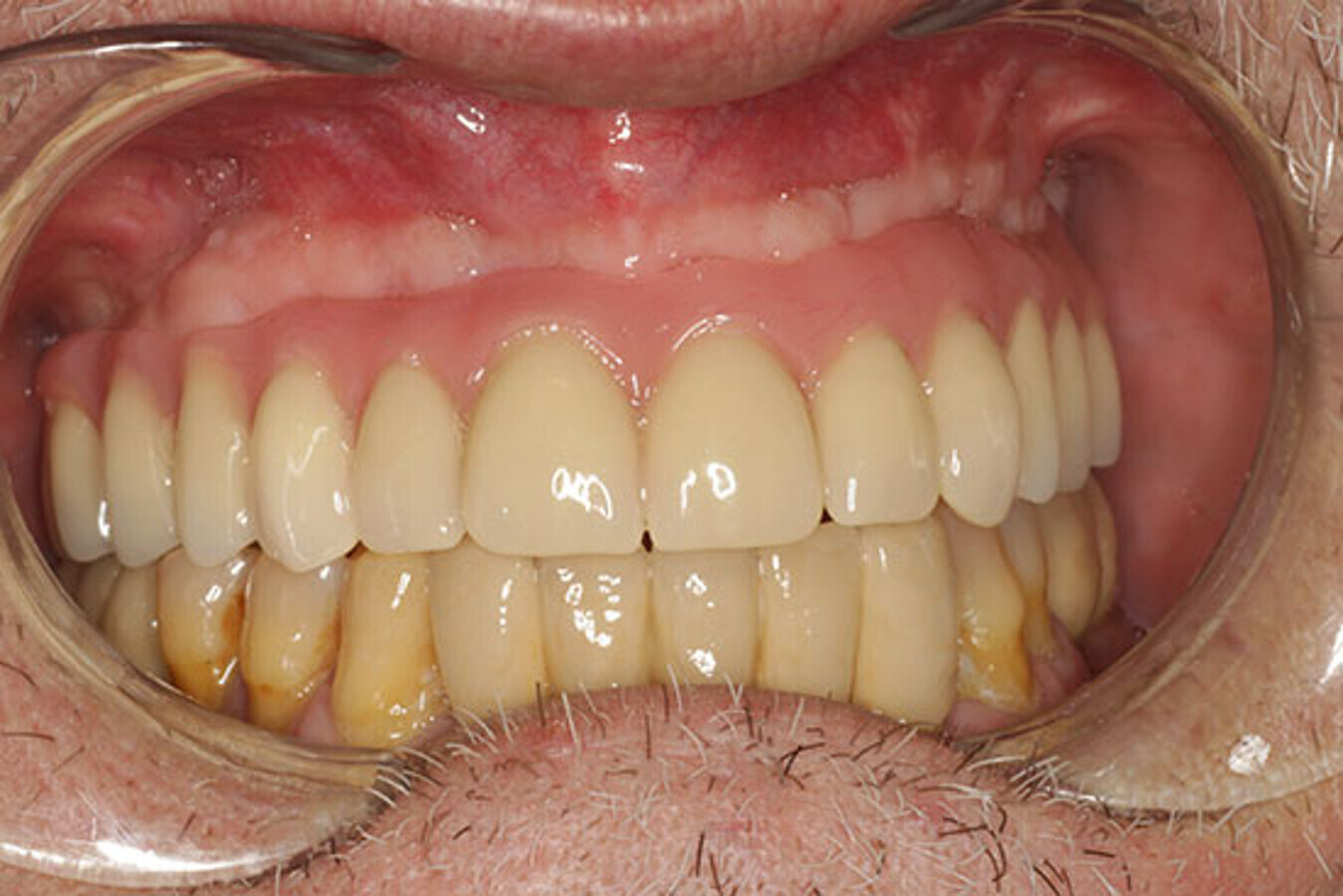 Fig. 25. Imagen intraoral de la prÃ³tesis definitiva de metal-composite.
