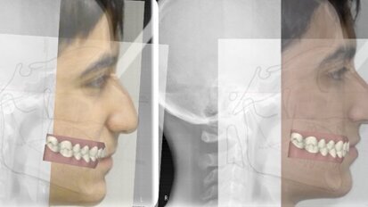 Il controllo del torque  degli incisivi superiori con  Invisalign: un case report
