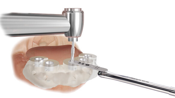 Materialise Dental triples its range of Universal SurgiGuide drill-key diameters