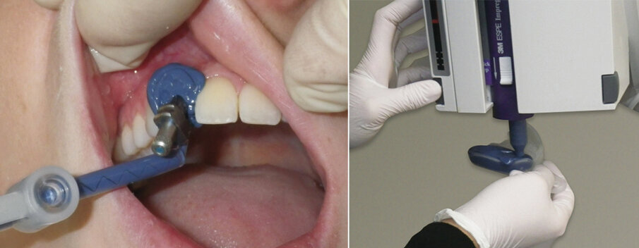 Fig. 10: Inject impression material around the impression coping while the dental assistant is loading the 3M™ Directed Flow Impression Tray using the 3M™ Pentamix™ 3 Automatic Mixing Unit.