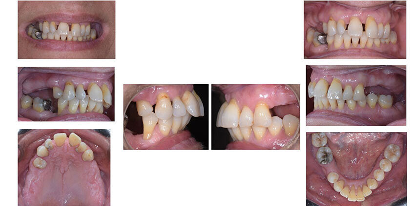 Fig. 3_Dopo l’estrazione dei denti 1.6, 1.7, 2.6.