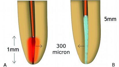 Le laser en endodontie (Partie II)