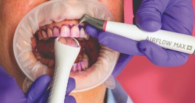 Guided Biofilm Therapy. Domande e risposte sulla soluzione sistematica per la gestione del biofilm