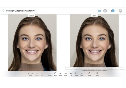Align Technology – Invisalign Outcome Simulator Pro
