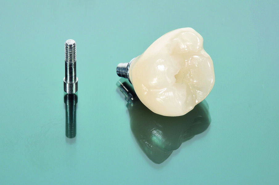 Fig. 12: The abutment crown made of VITA ENAMIC IS glued to the titanium base.