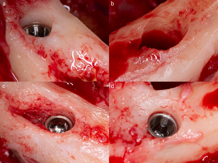 Fig. 6 - Fotografia intraoperatoria che evidenzia il posizionamento sotto-crestale degli impianti GTB inseriti nel mascellare inferiore. 6a: impianto in posizione 4.5. 6b: impianto in posizione 3.5. 6c: impianto in posizione 4.2. 6d: impianto in posizione 3.2.