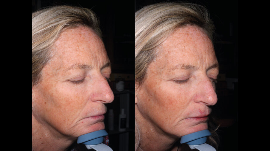 ; Fig. 4 - Pre e post trattamento.