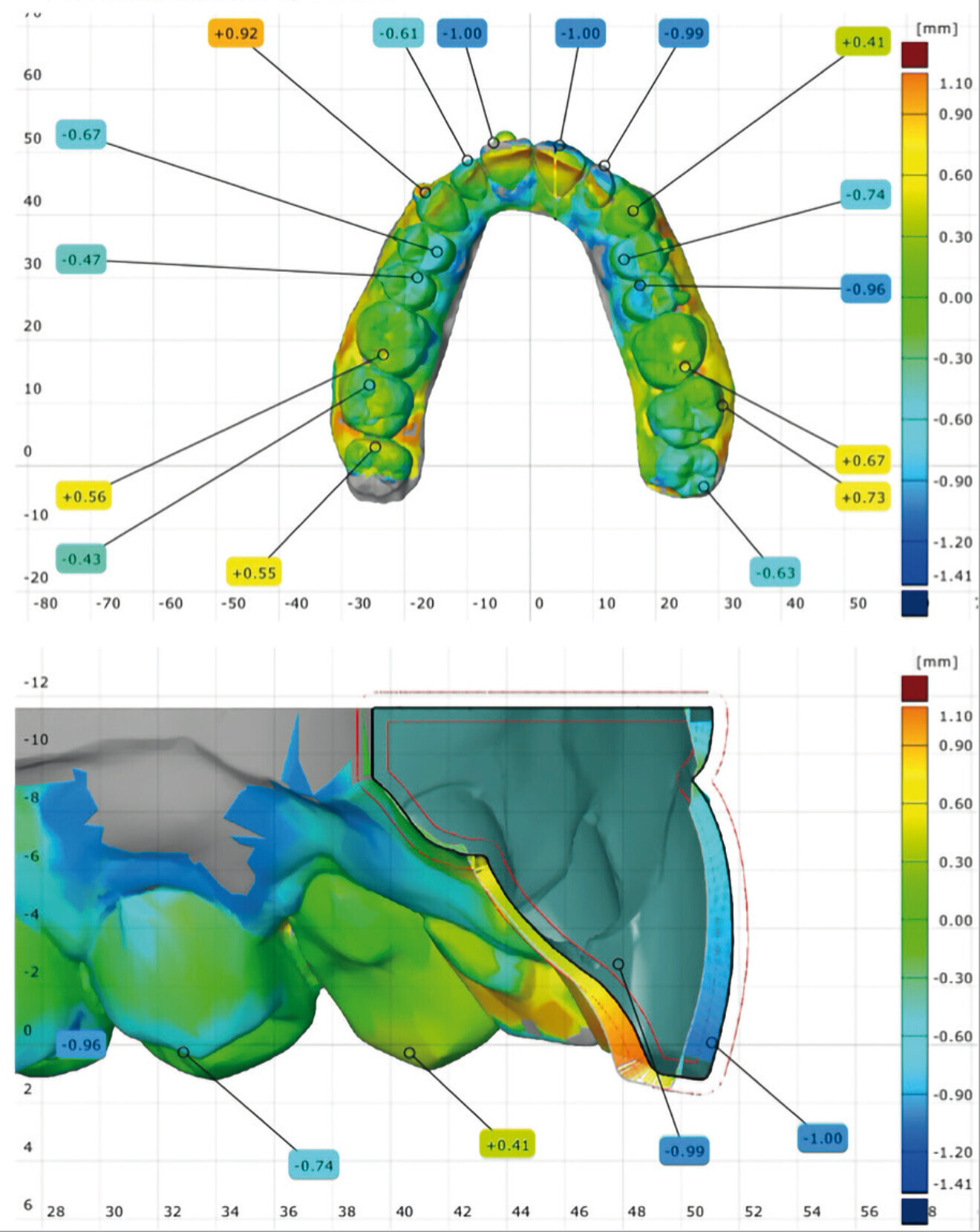 Fig. 23: Treatment evaluation report for the maxillary arch. Deviation analysis was done by superimposing the simulated treatment stage data in the CAD software on to the actual data obtained by scanning the patient’s teeth at the end of the third phase of the treatment.
